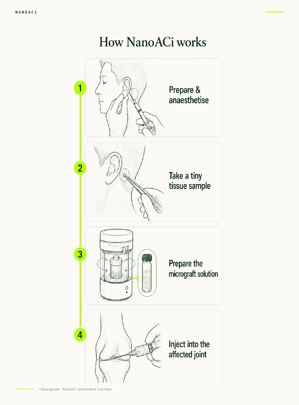 Four-step overview of the NanoACi point-of-care procedure